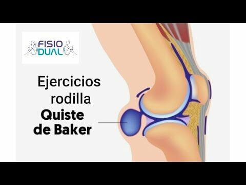 Consecuencias laborales del quiste de Baker: baja laboral y soluciones