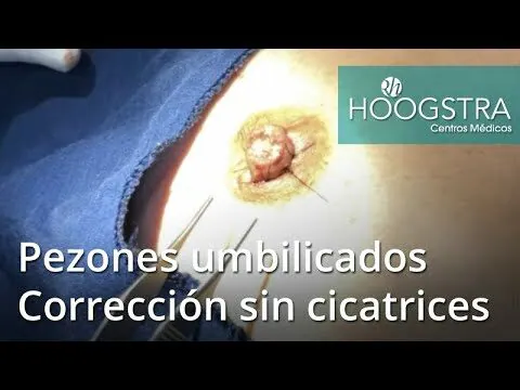 Operación de pezón invertido con cobertura de la Seguridad Social